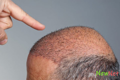 Do you want to take benefits of Hair Transplant Finance UK?